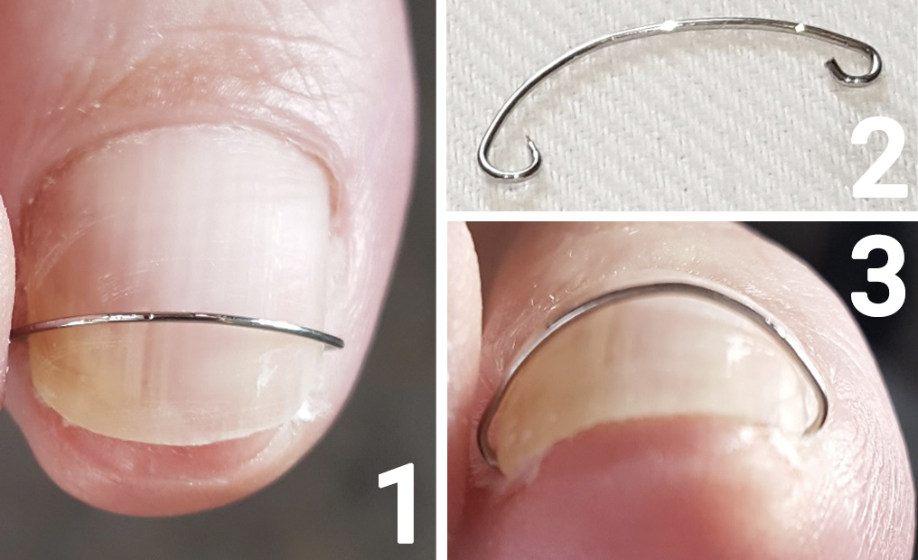 nagelbeugel