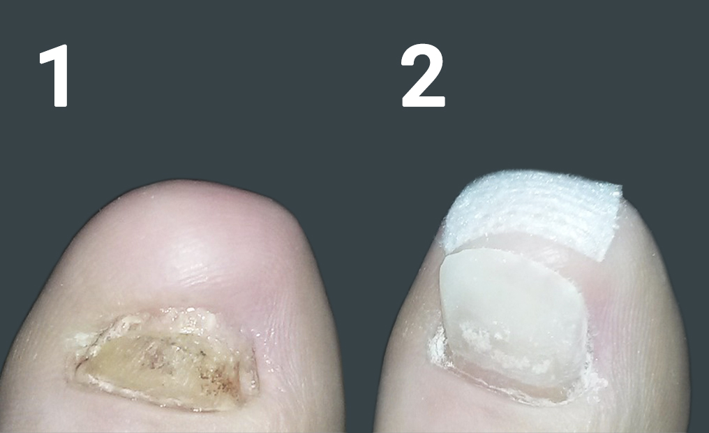 nagelreparatie
